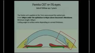 SICSSO 2016 - ENG - MEDAL LECTURE 2016 - J. H. Krumeich (Germany) - Femto Circular Keratotomy (Femto
