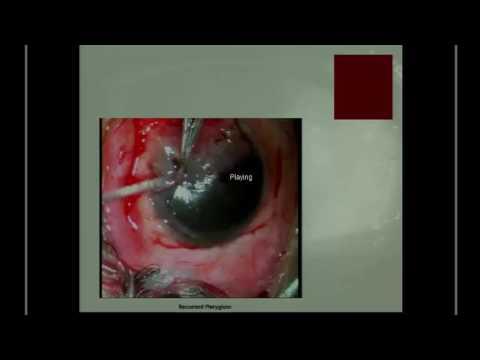 SICSSO 2016 - ENG - J. Suvira (India) - Pterygium surgery: the wings of change