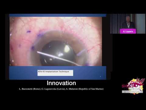 SICSSO 2018 - ENG - S. Lippera (Fabriano, AN) - Implantation of microbypass Xen gel stent after post