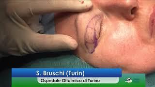 SICSSO 2019 - ITA - S. Bruschi (Turin) - Oculoplasty