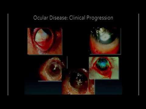 SICSSO 2016 - ENG - W. B. Lee (USA) - Ocular pemphigoid