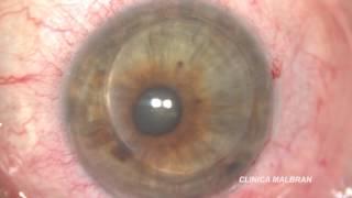 Video Surgery courtesy of E. Malbran (ARG) - Anular Lammellar Graft Post PK for Ectasia
