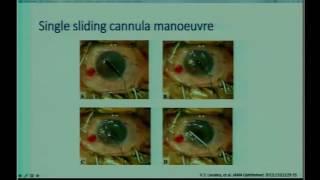 SICSSO 2016 - ENG - F. Sabatino (Roma) - Cannula assisted ab interno hydrounfolding technique in DME