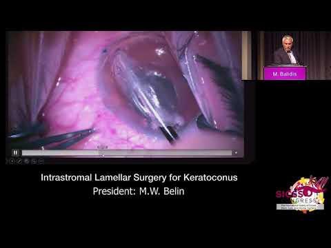 SICSSO 2018 - ENG - M. Balidis (Greece) - New experiences and perspectives of additive  keratoplasty
