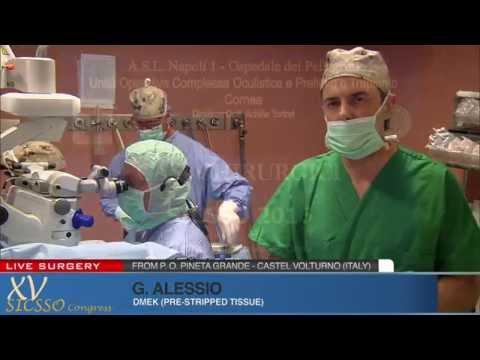 SICSSO 2016 - LIVE SURGERY - G. Alessio (Bari) - DMEK (pre-stripped tissue)