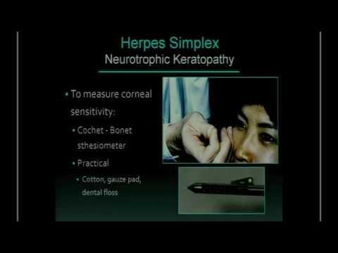 SICSSO 2016 - ITA - D. H. Scorsetti (Argentina) - Herpes Simplex Virus update
