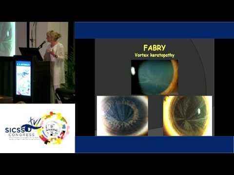 SICSSO 2017 - ENG - E. R. Antoniazzi (Pavia) - Vortex Keratopathy in Fabry Disease