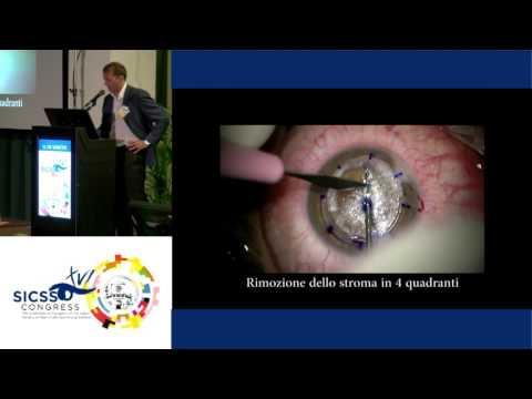 SICSSO 2017 - ITA - U. De Sanctis (Torino) - Deep anterior lamellar keratoplasty: big bubble formati
